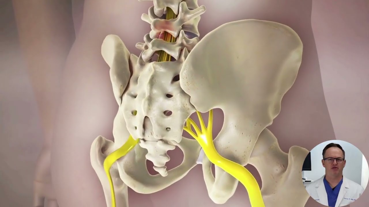 Epidural Steroid Injection