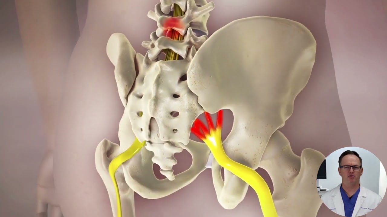 Lumbar Radiculopathy